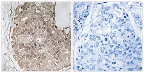 IHC of paraffin-embedded human breast carcinoma, using PARP4 Antibody. The picture on the right is treated with the synthesized peptide.