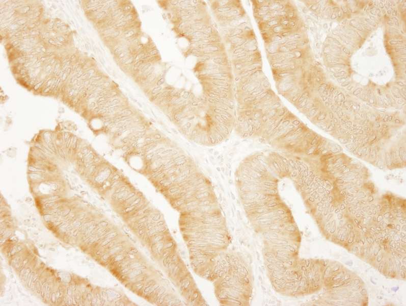 Detection of Human vPARP by Immunohistochemistry. Sample: FFPE section of human colon carcinoma. Antibody: Affinity purified rabbit anti-vPARP used at a dilution of 1:200 (1 ug/ml). Detection: DAB.