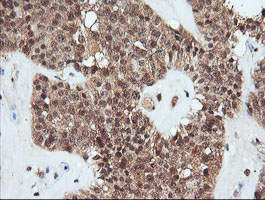 IHC of paraffin-embedded Carcinoma of Human pancreas tissue using anti-PARVA mouse monoclonal antibody.