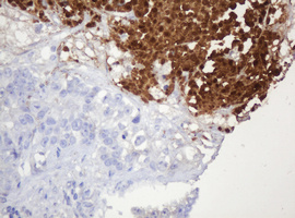 IHC of paraffin-embedded Adenocarcinoma of Human colon tissue using anti-PARVB mouse monoclonal antibody.