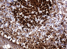 IHC of paraffin-embedded Adenocarcinoma of Human colon tissue using anti-PARVB mouse monoclonal antibody. (Heat-induced epitope retrieval by 10mM citric buffer, pH6.0, 120°C for 3min).
