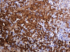 IHC of paraffin-embedded Adenocarcinoma of Human colon tissue using anti-PARVB mouse monoclonal antibody. (Heat-induced epitope retrieval by 10mM citric buffer, pH6.0, 120°C for 3min).