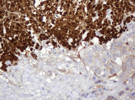 IHC of paraffin-embedded Adenocarcinoma of Human colon tissue using anti-PARVB mouse monoclonal antibody.