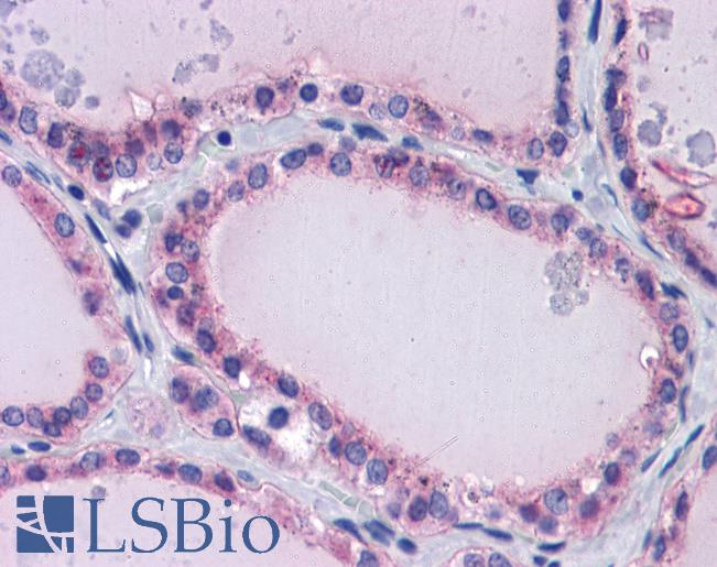 Anti-PAX8 antibody IHC of human thyroid. Immunohistochemistry of formalin-fixed, paraffin-embedded tissue after heat-induced antigen retrieval. Antibody LS-B5611 concentration 5 ug/ml.