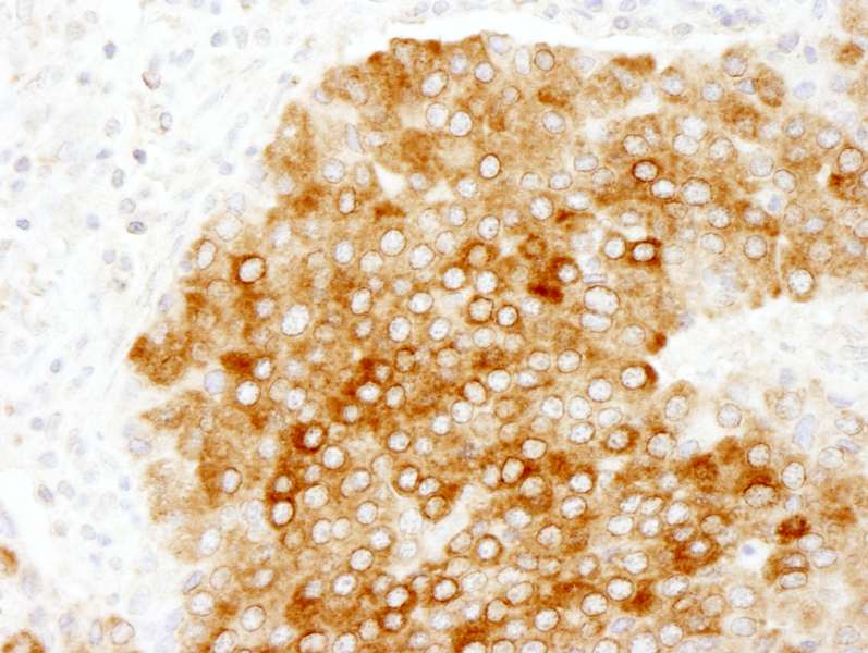 Detection of Human HPIP/PBXIP1 by Immunohistochemistry. Sample: FFPE section of human pancreatic islet cell tumor. Antibody: Affinity purified rabbit anti-HPIP/PBXIP1 used at a dilution of 1:200 (1 Detection: DAB.