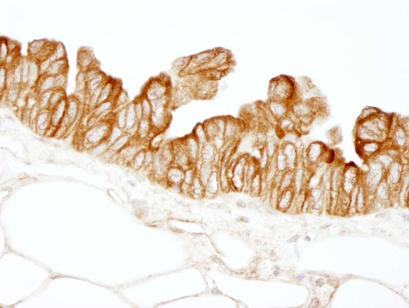Detection of Human HPIP by Immunohistochemistry. Sample: FFPE section of human ovarian carcinoma. Antibody: Affinity purified rabbit anti-HPIP used at a dilution of 1:100.