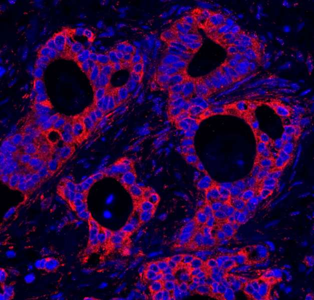 Detection of Human HPIP by IHC-IF. Sample: FFPE section of human ovarian carcinoma. Antibody: Affinity purified rabbit anti-HPIP used at a dilution of 1:100. Detection: Red-fluorescent goat anti-rabbit IgG highly cross-adsorbed Antibody Hilyte Plus 555 (A120-501E) used at a dilution of 1:100.