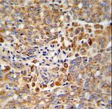 Formalin-fixed and paraffin-embedded human prostate carcinoma reacted with ALKBH3 Antibody , which was peroxidase-conjugated to the secondary antibody, followed by DAB staining. This data demonstrates the use of this antibody for immunohistochemistry; clinical relevance has not been evaluated.