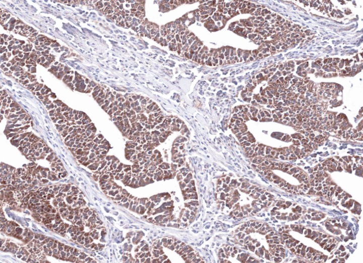 IHC of paraffin-embedded Lung Ad Cancer PC14 xenograft using PCCB (PCCB antibody ) antibody at 1:100 dilution.