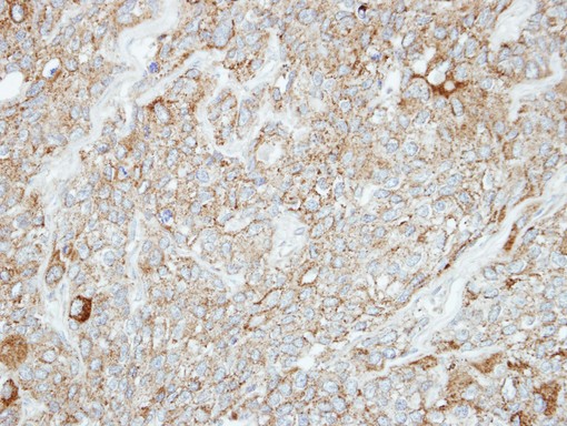 IHC of paraffin-embedded BT474 xenograft using PCDH1 antibody at 1:100 dilution.