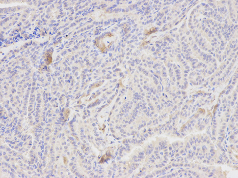 Immunohistochemistry of paraffin-embedded human thyroid cancer using PCK1 antibody at dilution of 1:200 (200x lens).