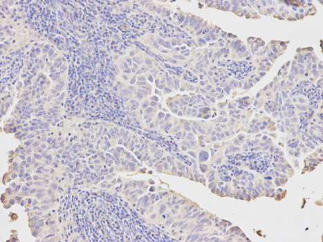 Immunohistochemistry of paraffin-embedded human endometrial cancer using PCK1 antibody at dilution of 1:200 (200x lens).