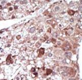 Formalin-fixed and paraffin-embedded human cancer tissue reacted with the primary antibody, which was peroxidase-conjugated to the secondary antibody, followed by DAB staining. This data demonstrates the use of this antibody for immunohistochemistry; clinical relevance has not been evaluated. BC = breast carcinoma; HC = hepatocarcinoma.
