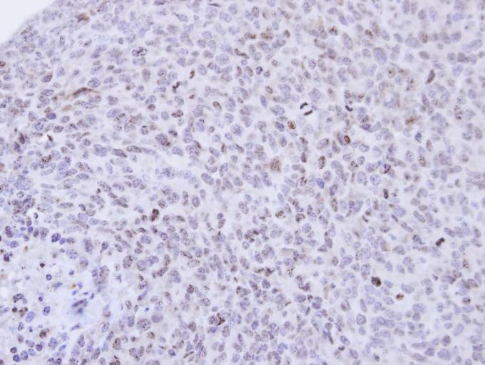 IHC of paraffin-embedded H1299 xenograft using PCNP antibody at 1:500 dilution.