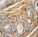PCOTH antibody immunohistochemistry of formalin-fixed and paraffin-embedded human prostate carcinoma followed by peroxidase-conjugated secondary antibody and DAB staining.