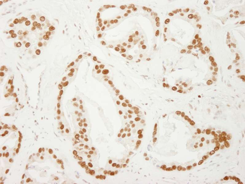 Detection of Human PC4 by Immunohistochemistry. Sample: FFPE section of human prostate carcinoma. Antibody: Affinity purified rabbit anti-PC4 used at a dilution of 1:250.