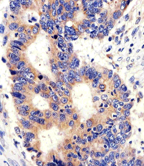 Immunohistochemical of paraffin-embedded H.colon carcinoma section using PCSK9 Antibody. Antibody was diluted at 1:100 dilution. A peroxidase-conjugated goat anti-rabbit IgG at 1:400 dilution was used as the secondary antibody, followed by DAB staining.