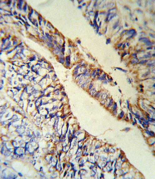 PCSK9 Antibody (RB18880) IHC of formalin-fixed and paraffin-embedded human Colon carcinoma followed by peroxidase-conjugated secondary antibody and DAB staining.
