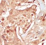 Formalin-fixed and paraffin-embedded human cancer tissue reacted with the primary antibody, which was peroxidase-conjugated to the secondary antibody, followed by DAB staining. This data demonstrates the use of this antibody for immunohistochemistry; clinical relevance has not been evaluated. BC = breast carcinoma; HC = hepatocarcinoma.