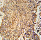 PCYXL Antibody immunohistochemistry of formalin-fixed and paraffin-embedded human Lung carcinoma followed by peroxidase-conjugated secondary antibody and DAB staining.
