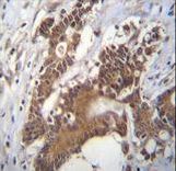 PCYT1A Antibody immunohistochemistry of formalin-fixed and paraffin-embedded human colon carcinoma followed by peroxidase-conjugated secondary antibody and DAB staining.