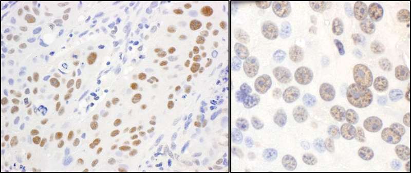 Detection of Human and Mouse Paf1 by Immunohistochemistry. Sample: FFPE sections of human lung carcinoma (left) and mouse renal cell carcinoma (right). Antibody: Affinity purified rabbit anti-Paf1 used at a dilution of 1:1000 (1 ug/ml). Detection: DAB.