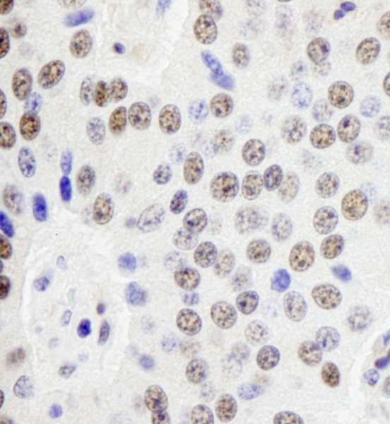 Detection of Human Paf1 by Immunohistochemistry. Sample: FFPE section of human pancreatic islet cell tumor. Antibody: Affinity purified rabbit anti-Paf1 used at a dilution of 1:250.