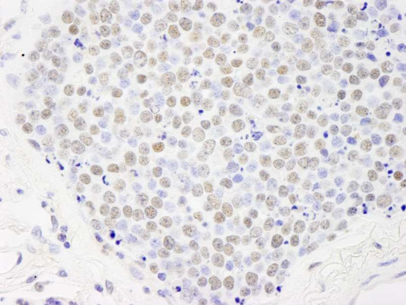Detection of Human Paf1 by Immunohistochemistry. Sample: FFPE section of human small cell lung cancer. Antibody: Affinity purified rabbit anti-Paf1 used at a dilution of 1:250.