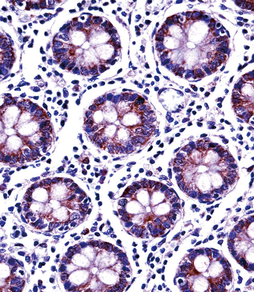 PDE11A Antibody immunohistochemistry of formalin-fixed and paraffin-embedded human colon tissue followed by peroxidase-conjugated secondary antibody and DAB staining.