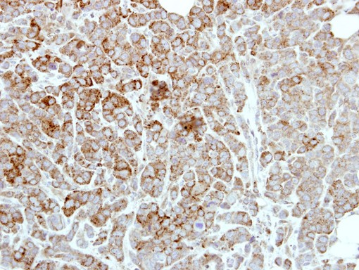 IHC of paraffin-embedded MDAMB468 xenograft using PDE1A antibody at 1:500 dilution.