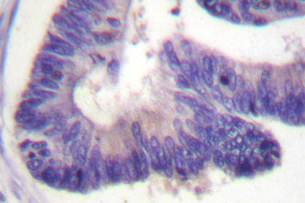 IHC of PDE4B/C/D (H47) pAb in paraffin-embedded human colon carcinoma tissue.