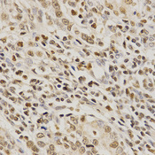 Immunohistochemistry of paraffin-embedded human stomach cancer using PDE4D antibody at dilution of 1:200 (x400 lens).