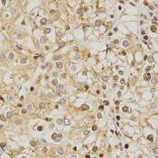 Immunohistochemistry of paraffin-embedded human kidney cancer using PDE4D antibody at dilution of 1:200 (x400 lens).
