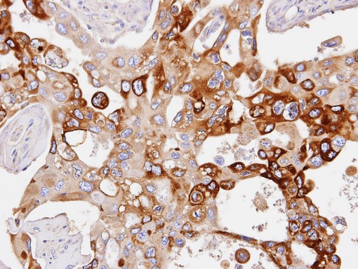 IHC of paraffin-embedded H441 xenograft using PDE4D antibody at 1:100 dilution.