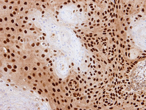 IHC of paraffin-embedded SAS xenograft using PDE6D antibody at 1:500 dilution.