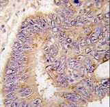Formalin-fixed and paraffin-embedded human colon carcinoma tissue reacted with PDE8A antibody (L572), which was peroxidase-conjugated to the secondary antibody, followed by DAB staining. This data demonstrates the use of this antibody for immunohistochemistry; clinical relevance has not been evaluated.