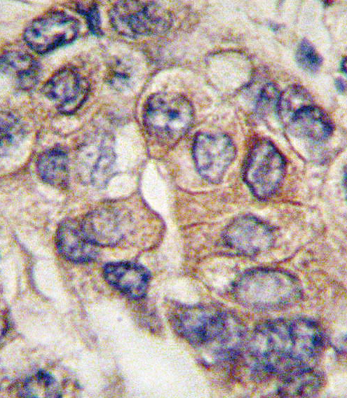 Formalin-fixed and paraffin-embedded human hepatocarcinoma tissue reacted with PDGFRA Antibody (Y720) , which was peroxidase-conjugated to the secondary antibody, followed by DAB staining. This data demonstrates the use of this antibody for immunohistochemistry; clinical relevance has not been evaluated.