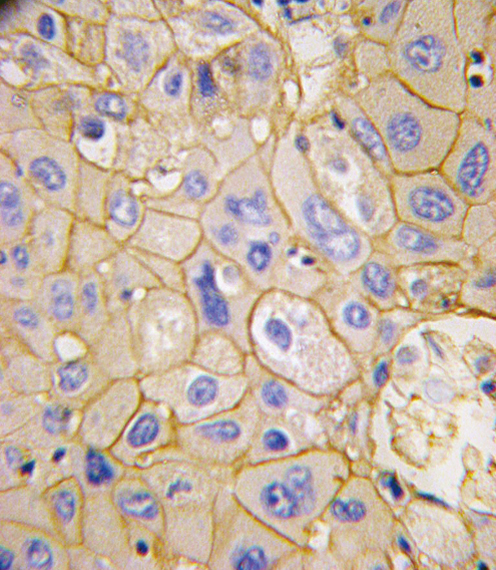 Formalin-fixed and paraffin-embedded human hepatocarcinoma tissue reacted with PDGFRA Antibody (Y754), which was peroxidase-conjugated to the secondary antibody, followed by DAB staining. This data demonstrates the use of this antibody for immunohistochemistry; clinical relevance has not been evaluated.