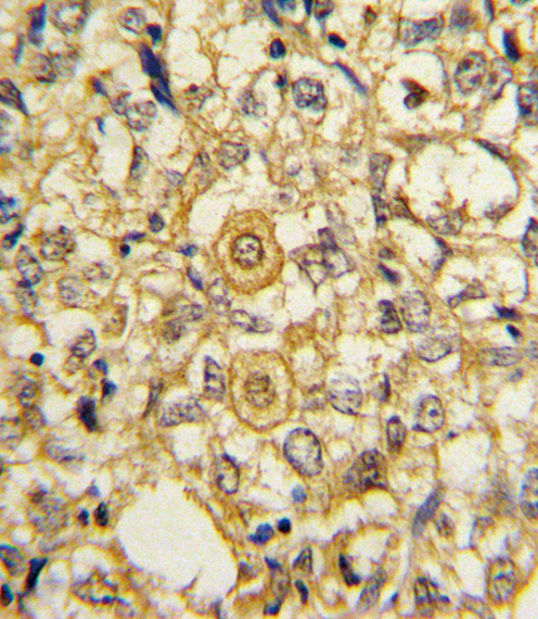 Formalin-fixed and paraffin-embedded human breast carcinoma reacted with PDGFRB Antibody , which was peroxidase-conjugated to the secondary antibody, followed by DAB staining. This data demonstrates the use of this antibody for immunohistochemistry; clinical relevance has not been evaluated.