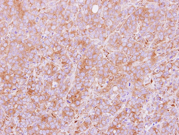 IHC of paraffin-embedded MCF7 xenograft using PDIR antibody at 1:100 dilution.