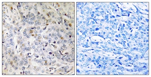 IHC of paraffin-embedded human breast carcinoma tissue, using PDIK1L Antibody. The sample on the right was incubated with synthetic peptide.