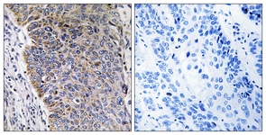 IHC of paraffin-embedded human lung carcinoma tissue, using MGST3 Antibody. The picture on the right is treated with the synthesized peptide.