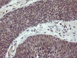 IHC of paraffin-embedded Carcinoma of Human bladder tissue using anti-PDLIM2 mouse monoclonal antibody. (Heat-induced epitope retrieval by 10mM citric buffer, pH6.0, 100C for 10min).