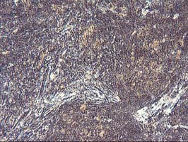 IHC of paraffin-embedded Human lymphoma tissue using anti-PDLIM2 mouse monoclonal antibody. (Heat-induced epitope retrieval by 10mM citric buffer, pH6.0, 100C for 10min).