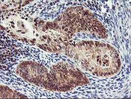 IHC of paraffin-embedded Adenocarcinoma of Human endometrium tissue using anti-PDLIM2 mouse monoclonal antibody. (Heat-induced epitope retrieval by 10mM citric buffer, pH6.0, 100C for 10min).