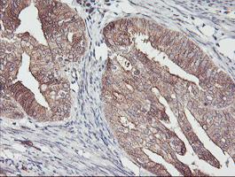 IHC of paraffin-embedded Adenocarcinoma of Human endometrium tissue using anti-PDRG1 mouse monoclonal antibody. (Heat-induced epitope retrieval by 10mM citric buffer, pH6.0, 100C for 10min).