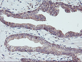 IHC of paraffin-embedded Carcinoma of Human prostate tissue using anti-PDRG1 mouse monoclonal antibody. (Heat-induced epitope retrieval by 10mM citric buffer, pH6.0, 100C for 10min).