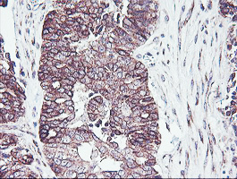 IHC of paraffin-embedded Adenocarcinoma of Human ovary tissue using anti-PDRG1 mouse monoclonal antibody. (Heat-induced epitope retrieval by 10mM citric buffer, pH6.0, 100C for 10min).