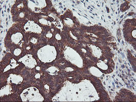 IHC of paraffin-embedded Adenocarcinoma of Human colon tissue using anti-PDRG1 mouse monoclonal antibody. (Heat-induced epitope retrieval by 10mM citric buffer, pH6.0, 100C for 10min).