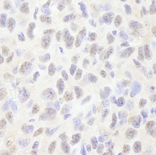 Detection of Mouse Pds5B by Immunohistochemistry. Sample: FFPE section of mouse squamous cell carcinoma. Antibody: Affinity purified rabbit anti-Pds5B used at a dilution of 1:250.